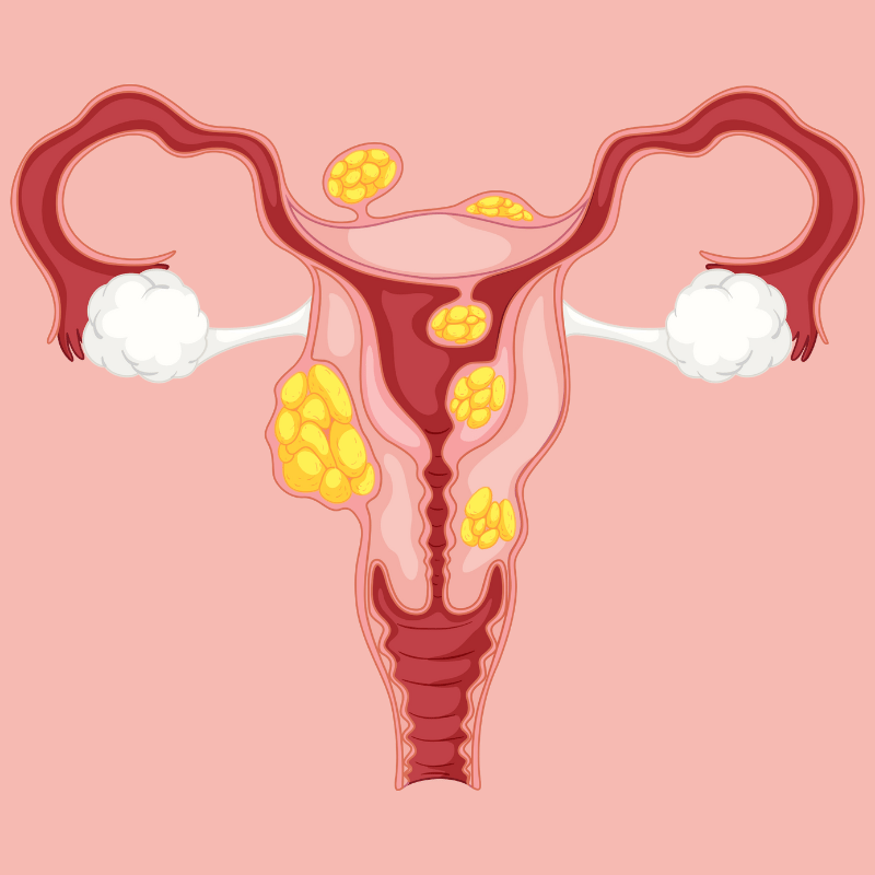 Fibroids